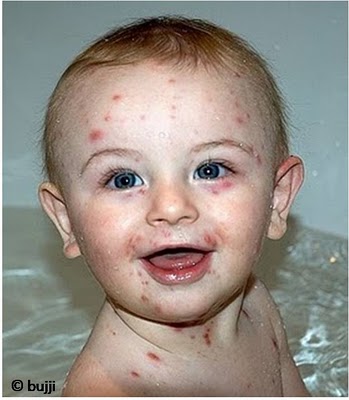 chicken pox baby. The Chicken Pox is well-termed